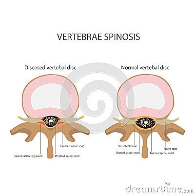 Spin stenosis. vertebrae disease Vector Illustration