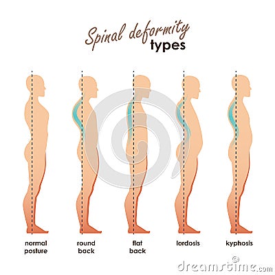 Spinal deformity types. Diseases of the spine.Lordosis, kyphosis, round back, flat back. Vector human silhouettes Vector Illustration