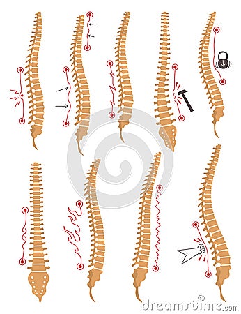 Spinal deformity types. Symbols of spine curvatures or unhealthy backbones. Human spine anatomy, curved spine. Diagram Vector Illustration