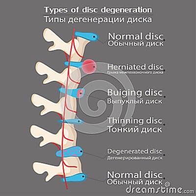 Spinal disc degeneration illustration, educational medical illustration, spine disease options, flat style, idea for Vector Illustration