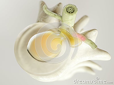 Spinal disc herniation as close-up detailed 3D Rendering Stock Photo