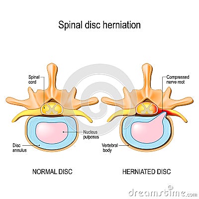 Normal disc and spinal disc herniation in cervical vertebrae Vector Illustration