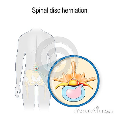 Spinal disc herniation Vector Illustration