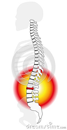 Spinal Disc Prolapse Herniation Vector Illustration