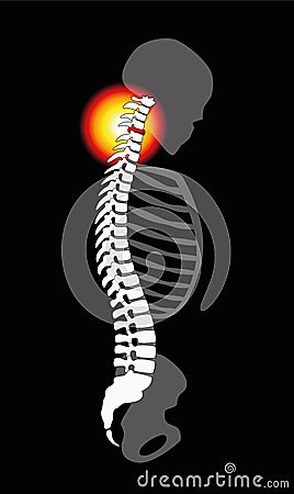 Spinal Disc Prolapse Neck Pain Cervical Vertebrae Vector Illustration