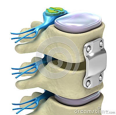 Spinal fixation system - titanium bracket Stock Photo