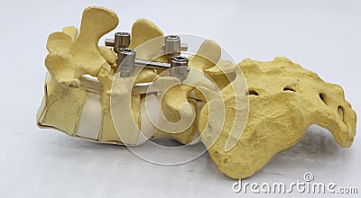 Spinal fixation system - titanium bracket Stock Photo