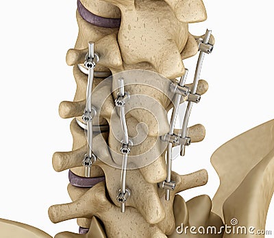 Spinal fixation system - titanium bracket. Cartoon Illustration