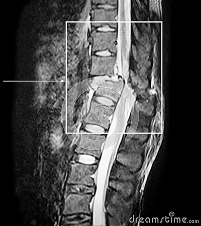 Fracture spin, cord interruption, compression. CT-scan. Stock Photo