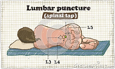 Spinal Lumbar Puncture Illustration on old Paper Stock Photo