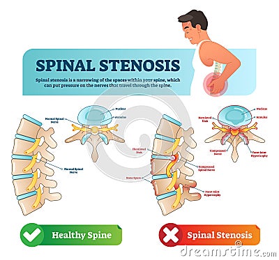 Spinal stenosis vector illustration. Labeled medical scheme. Diagram with nucleus, annulus, bone spurs and compressed spinal nerve Vector Illustration