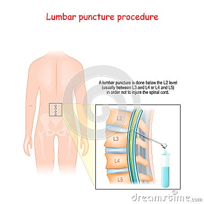 Spinal Tap Procedure. Detailed diagram of lumbar puncture Vector Illustration