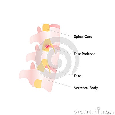 Spine cord vector flat anatomical illustration with text and disc prolapse. Design for science, biology, health care Vector Illustration