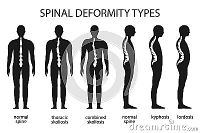 Spine deformity vector illustration. Kyphosis, lordosis spine infographic. Vector Illustration