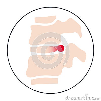 intervertebral hernia concept Vector Illustration