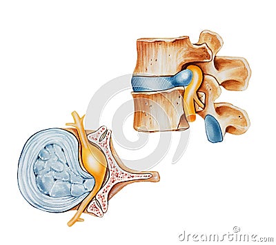 Spine - Herniated Slipped or Ruptured Disc Stock Photo