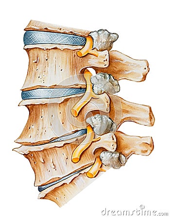 Spine - Lumbar Osteoarthritic and Spondylitic Arthritis Stock Photo