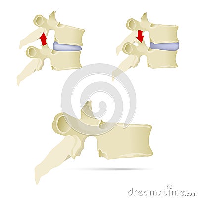Spine, lumbar vertebra. Facet syndrome, advanced uncovertebral a Vector Illustration