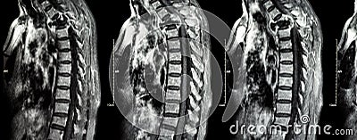 Spine metastasis ( cancer spread to thoracic spine ) Stock Photo