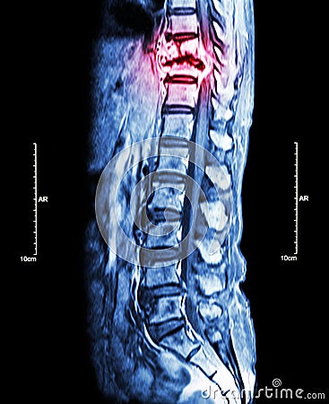 Spine metastasis ( cancer spread to thoracic spine ) ( MRI of thoracic and lumbar spine : show thoracic spine metastasis and compr Stock Photo