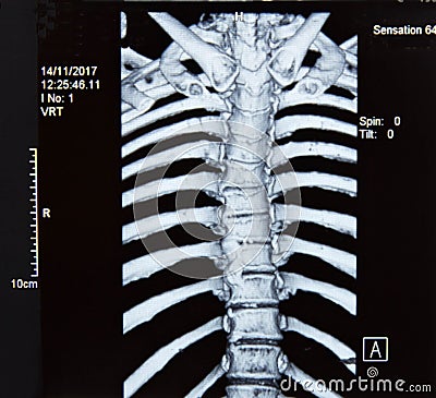 Spine MRI x-ray Stock Photo