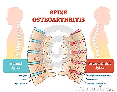 Spine osteoarthritis anatomical vector illustration diagram Vector Illustration