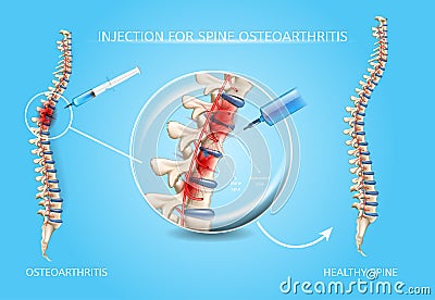 Spine Osteoarthritis Medical Treatment Vector Vector Illustration