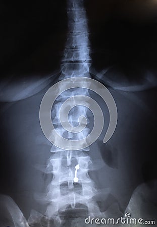 Spine Radiography - X Rays Stock Photo