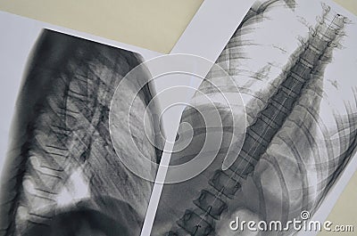 Spine Rengen picture Stock Photo