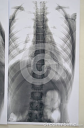 Spine Rengen picture Stock Photo