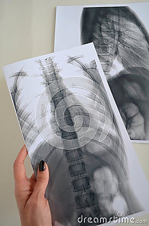 Spine Rengen picture Stock Photo