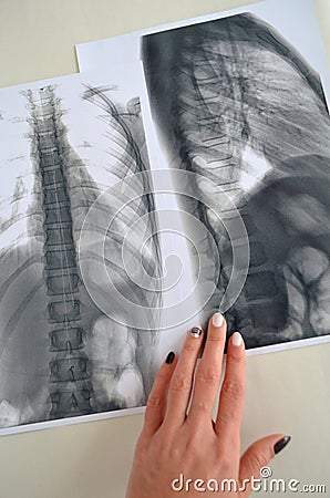 Spine Rengen picture Stock Photo