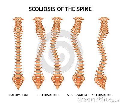 Spine Scoliosis Anatomy Infographics Vector Illustration