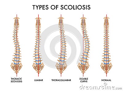 Spine Scoliosis Realistic Set Vector Illustration