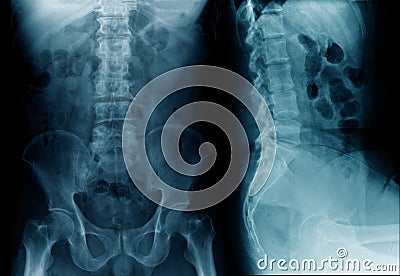 Spine x-ray Stock Photo