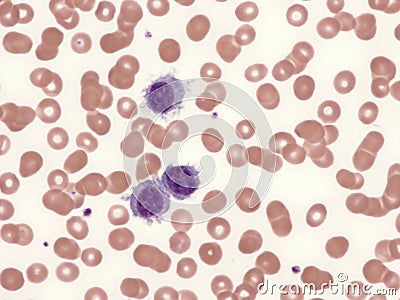 Splenic lymphoma with circulating villous lymphocytes. Stock Photo