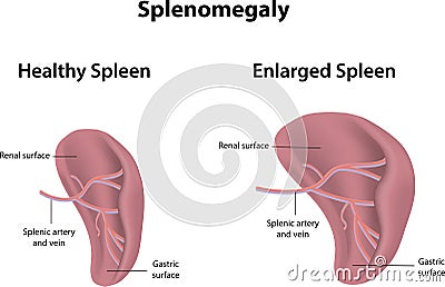 What are some symptoms of an enlarged spleen?