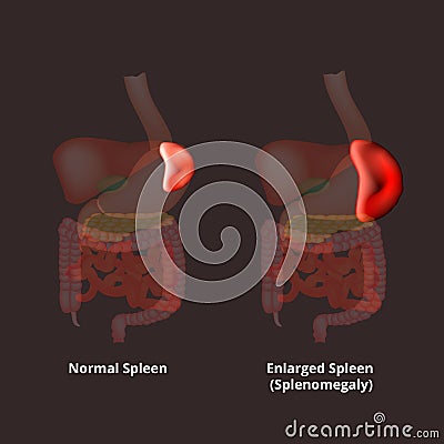 Splenomegaly of the spleen. Enlargement of the spleen. Vector illustration on isolated background Cartoon Illustration