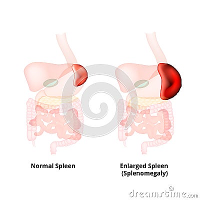 Splenomegaly of the spleen. Enlargement of the spleen. Vector illustration on isolated background Cartoon Illustration