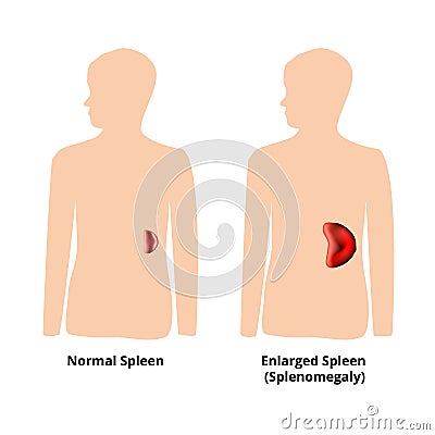 Splenomegaly of the spleen. Enlargement of the spleen. Vector illustration on isolated background Cartoon Illustration