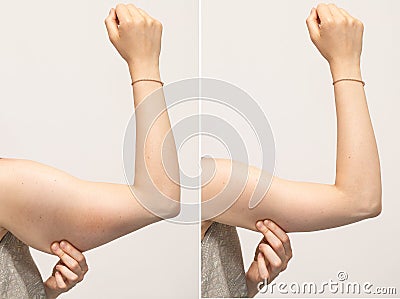 A split screen of a woman pinching the skin beneath her arm. Stock Photo