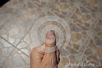 Splitting nail with blood clotting Stock Photo