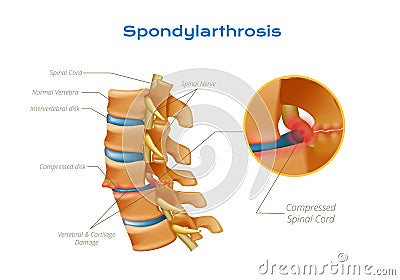 Spondylarthrosis Spinal Cord Infographics Vector Illustration