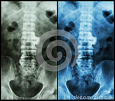 Spondylosis ( film x-ray lumbo - sacral spine : show spondylosis at L2-3 ) Stock Photo