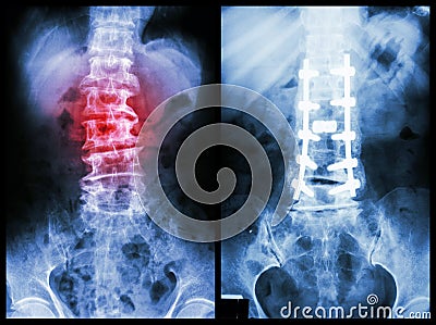 Spondylosis Stock Photo