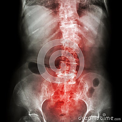 Spondylosis and Scoliosis ( film x-ray lumbar - sacrum spine show crooked spine ) ( old patient ) ( Spine Healthcare ) Stock Photo