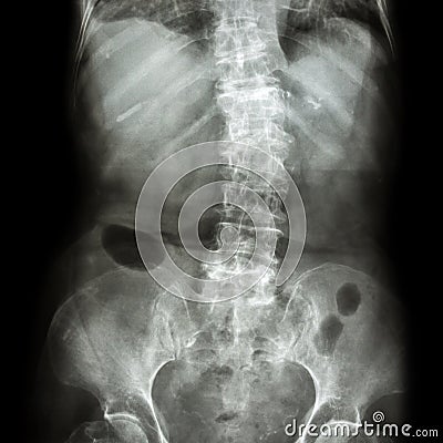 Spondylosis and Scoliosis ( film x-ray lumbar - sacrum spine show crooked spine ) ( old patient ) ( Spine Healthcare ) Stock Photo