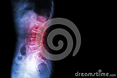 Spondylosis , Spondylolisthesis ( Film x-ray lumbo - sacral spine show spine collapse , decrease in disc space , bony spur format Stock Photo