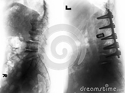 Spondylosis . Before and After surgery . Stock Photo
