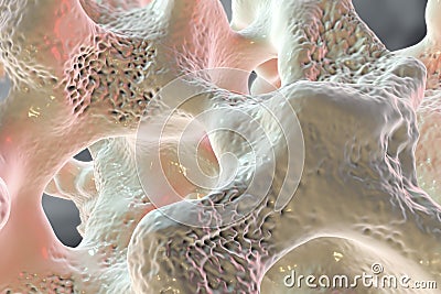 Spongy bone tissue affected by osteoporosis Cartoon Illustration